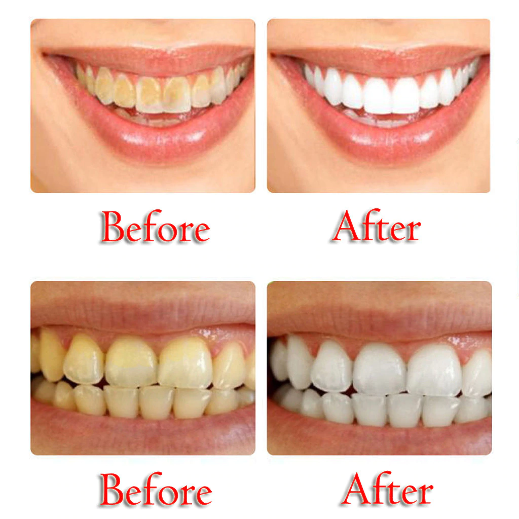 להילחם הסרת כתמים הלבנת שיניים חניכיים מדממות משחת שיניים חזקות ניקוי Power מסיר כתמים הלבנת שיניים